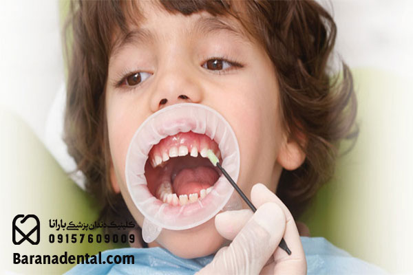 چرا فلورایدتراپی برای کودکان ضروری است؟