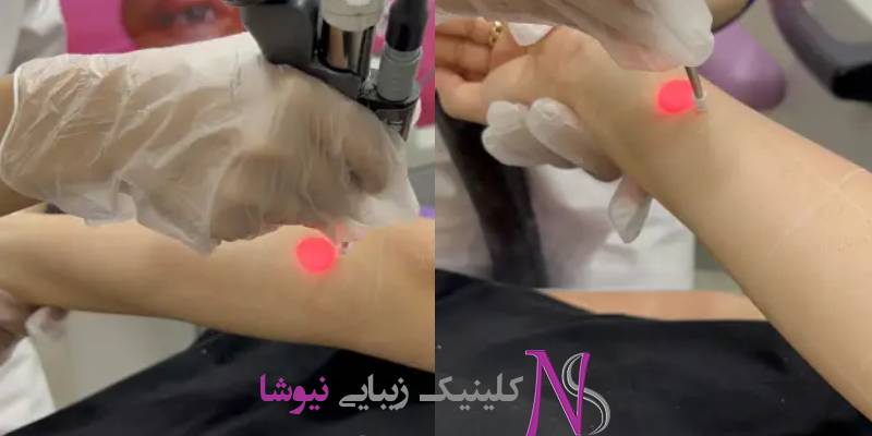 لیزر فول بادی راهی سریع و دائمی برای خلاص شدن از موهای زائد